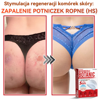 ✅✅ GFOUK® Plastry do usuwania brodawek i znamion z mikronakłuciami roślinnymi