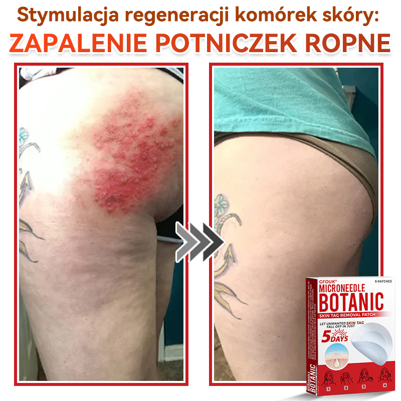 ✅✅ GFOUK® Plastry do usuwania brodawek i znamion z mikronakłuciami roślinnymi