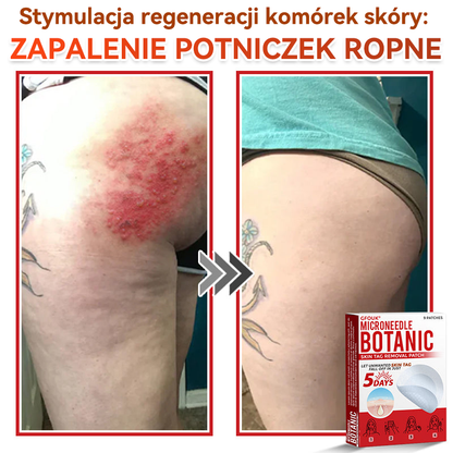 ✅✅ GFOUK® Plastry do usuwania brodawek i znamion z mikronakłuciami roślinnymi