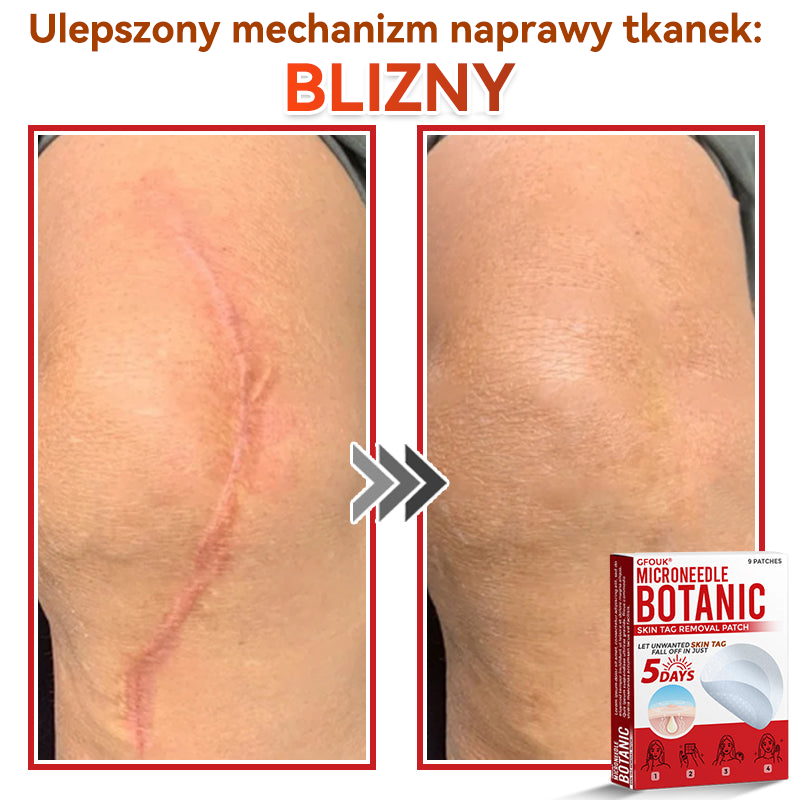 ✅✅ GFOUK® Plastry do usuwania brodawek i znamion z mikronakłuciami roślinnymi