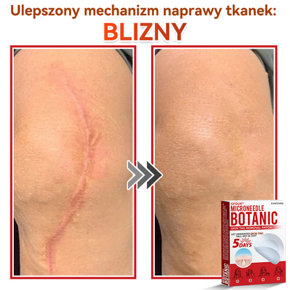 ✅✅ GFOUK® Plastry do usuwania brodawek i znamion z mikronakłuciami roślinnymi