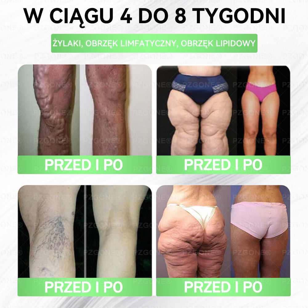 💞Oficjalny Sklep | 👩‍⚕️🎁 𝐏𝐙𝐆𝐎𝐍𝐄® Superfood 𝑵𝒂𝒏𝒐 Mikronakłuwana Plaster 🇵🇱(Tylko raz dziennie, widoczne zmiany już w 7 dni)✅ Na otyłość, 🅛🅞🅞🅢🅔 🅢🅚🅘🅝 wiotką skórę, cukrzycę, bezdech senny, problemy ze stawami i wiele więcej