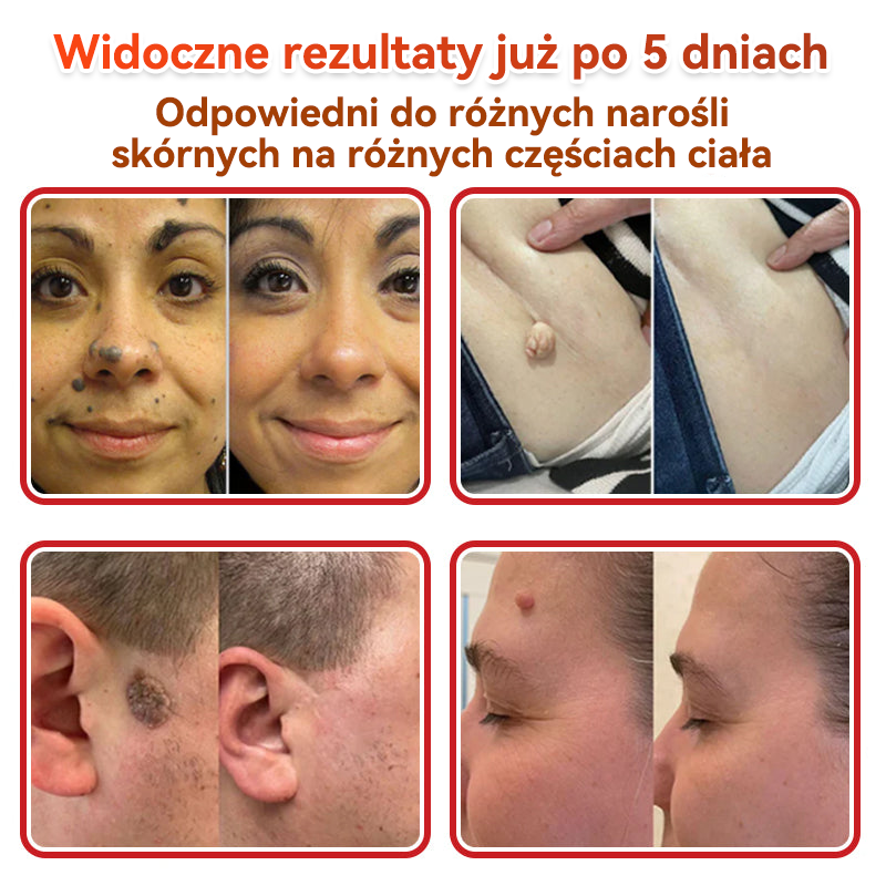 ✅✅ GFOUK® Plastry do usuwania brodawek i znamion z mikronakłuciami roślinnymi