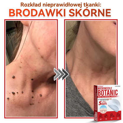✅✅ GFOUK® Plastry do usuwania brodawek i znamion z mikronakłuciami roślinnymi