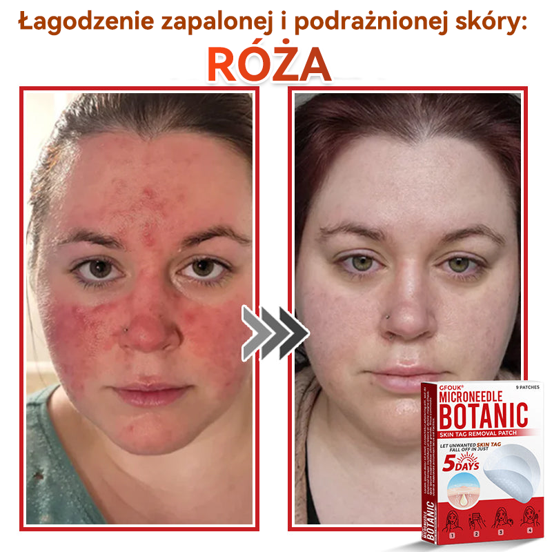 ✅✅ GFOUK® Plastry do usuwania brodawek i znamion z mikronakłuciami roślinnymi