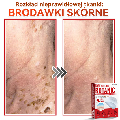 ✅✅ GFOUK® Plastry do usuwania brodawek i znamion z mikronakłuciami roślinnymi