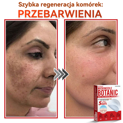 ✅✅ GFOUK® Plastry do usuwania brodawek i znamion z mikronakłuciami roślinnymi