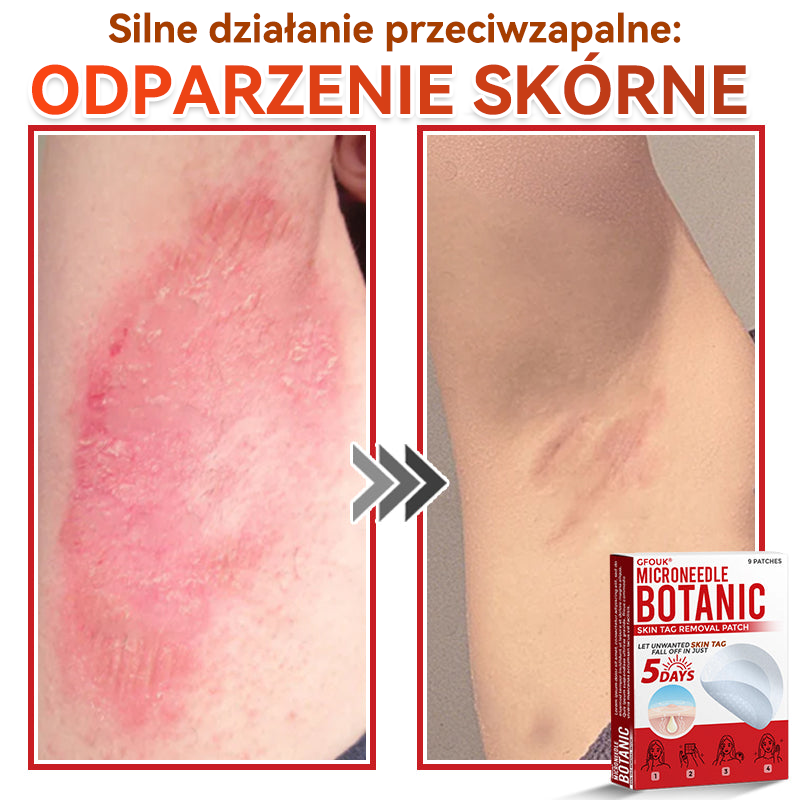 ✅✅ GFOUK® Plastry do usuwania brodawek i znamion z mikronakłuciami roślinnymi